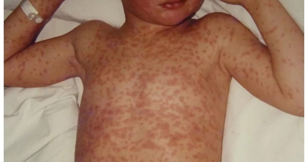 Measles, high risk of death.  Dr. Mihai Craiu: "Don't play Russian roulette with your own child.  The price paid would be too high!"