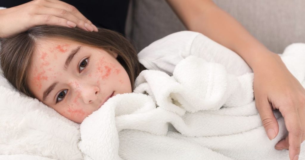 777 new measles cases recorded last week