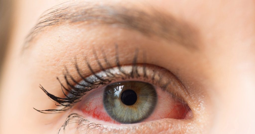 Spring eye allergies.  "We are happy that the trees have blossomed, but we have to be careful"