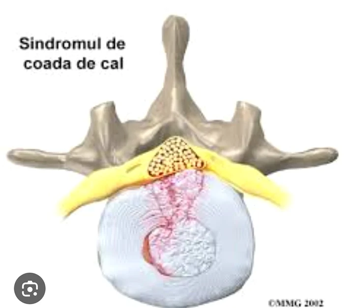 Pony tail syndrome PHOTO Facebook Răzvan Darea