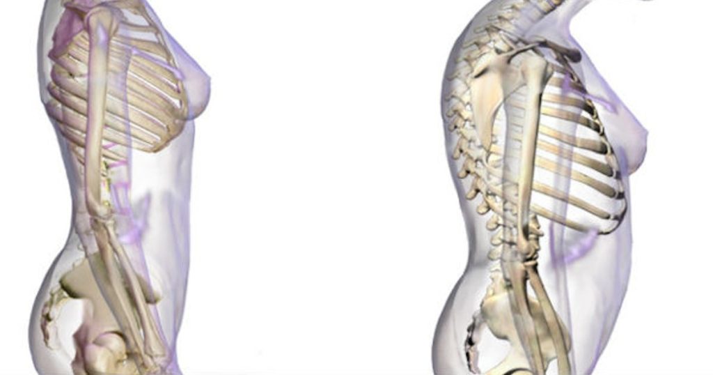 Why osteoporosis is more common in women than men.  The foods that must be included in the diet