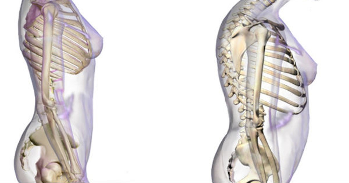 Why osteoporosis is more common in women than men.  The foods that must be included in the diet