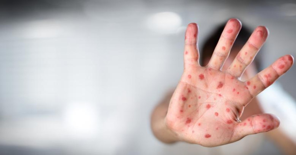 Healthy and vaccinated child, died of measles in Constanța.  The causes of the tragedy explained by specialists