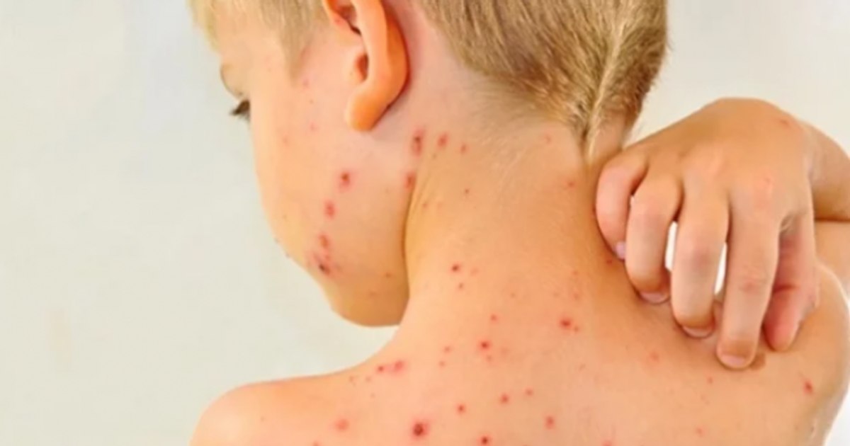 Measles remains at high levels in the country.  646 new cases reported in the last week