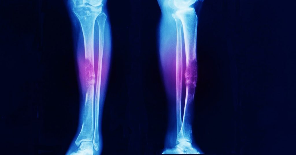 A gelatinous injectable, non-surgical joint healing solution.  It could also treat osteoarthritis