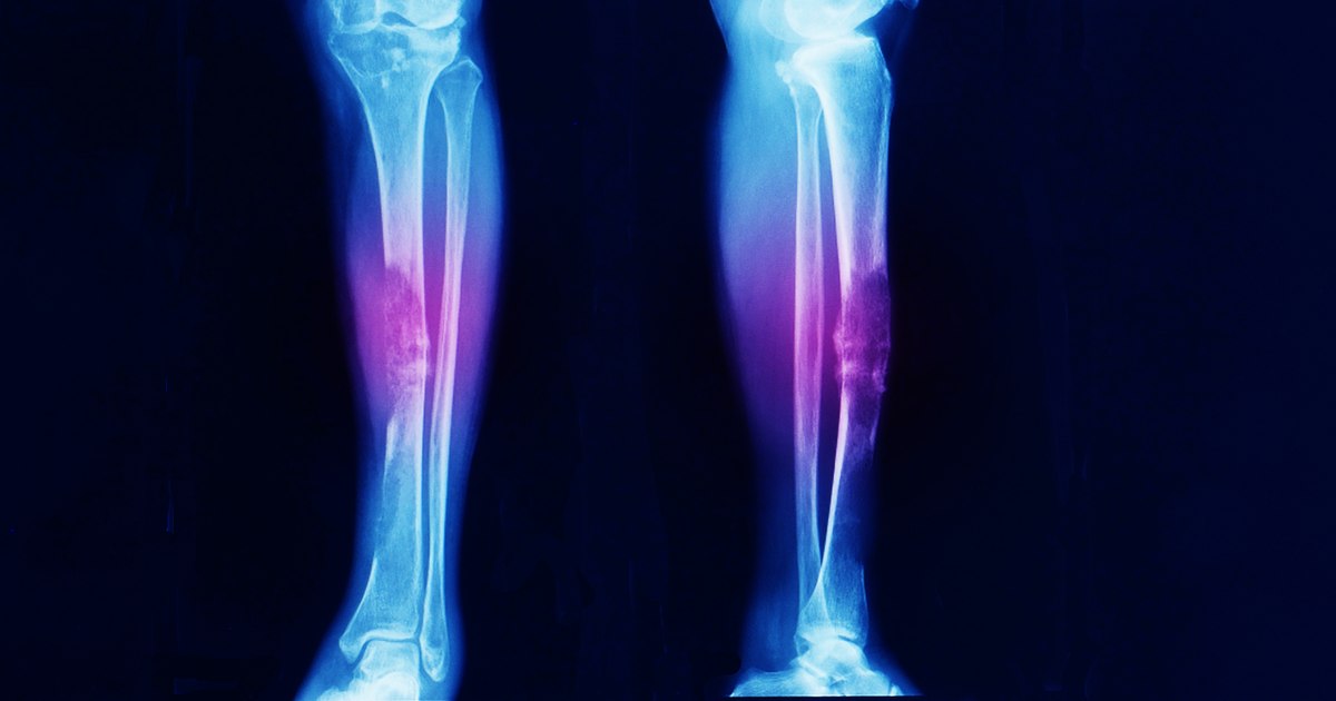 A gelatinous injectable, non-surgical joint healing solution.  It could also treat osteoarthritis