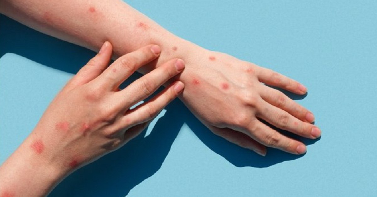 Doctor Adrian Marinescu, about monkey pox: "We have had isolated cases including in Romania in the past years"