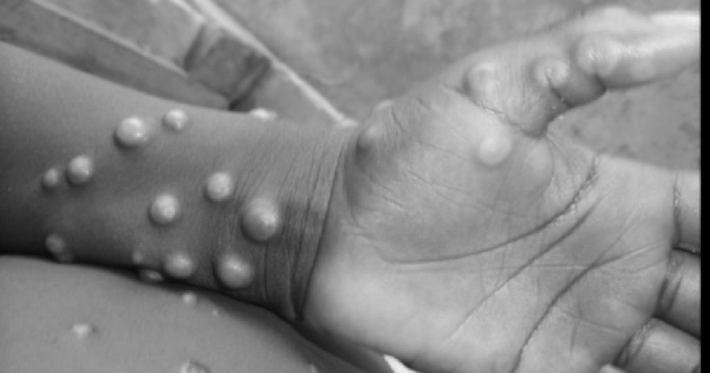 Thailand confirms Asia's first known case of the new, more deadly variant of monkeypox