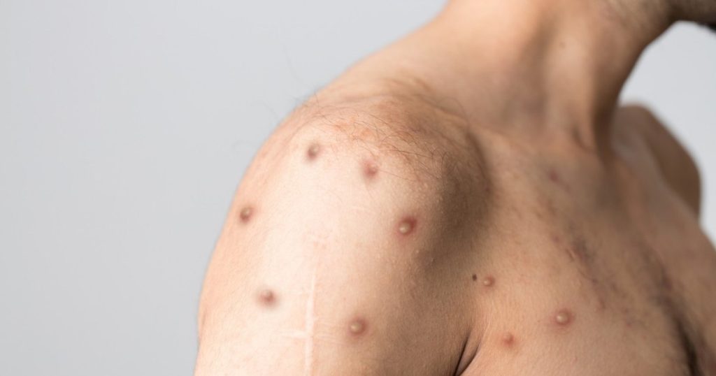 Monkeypox vaccines could be used for children and teenagers. What measures did China take after the WHO alert