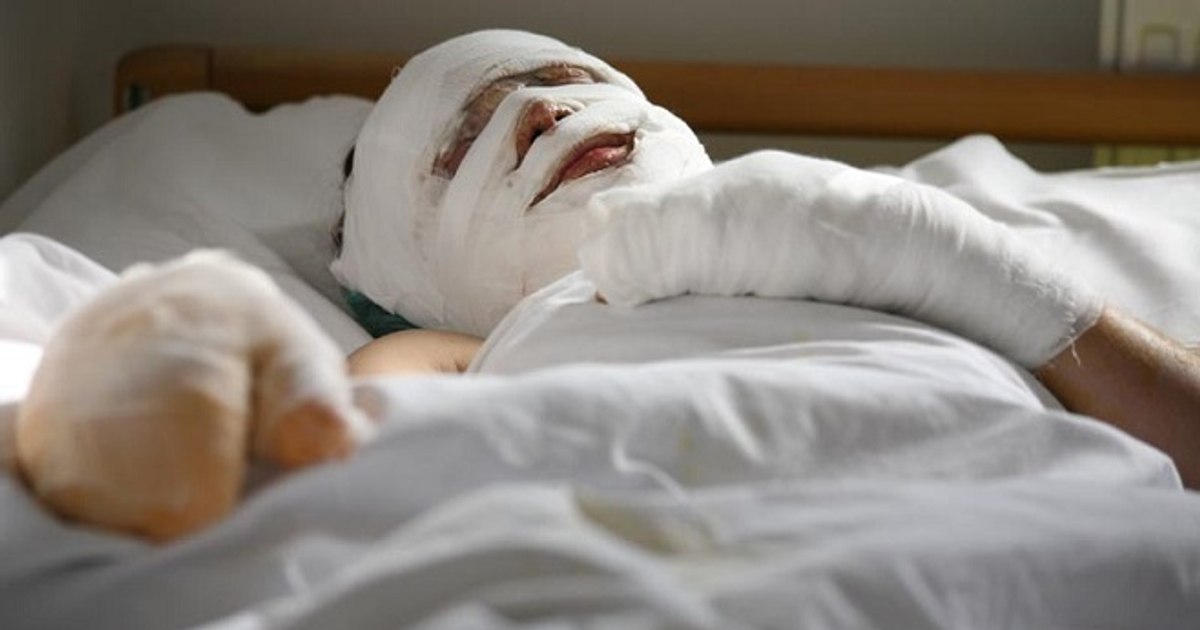 The reason why a young man with severe burns was refused by the major hospitals in the country