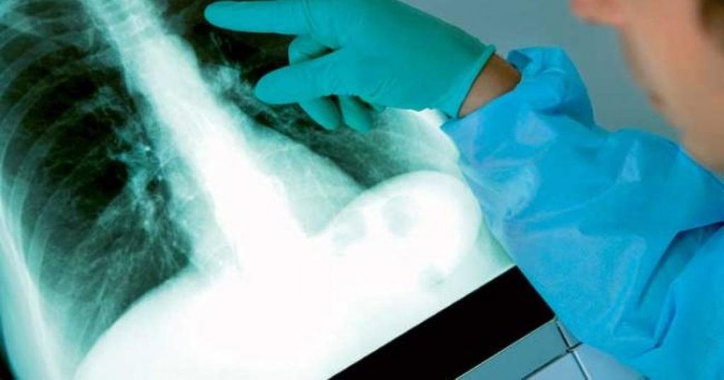 Tuberculosis is again at the top of the list of deaths caused by infectious diseases. Pulmonologist: "We expected an increase"