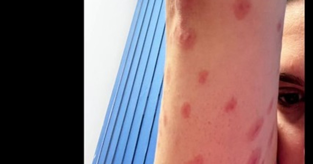 Video A student living in a dormitory in Regie arrived at the doctor bitten by bedbugs. How does the University of Bucharest respond?