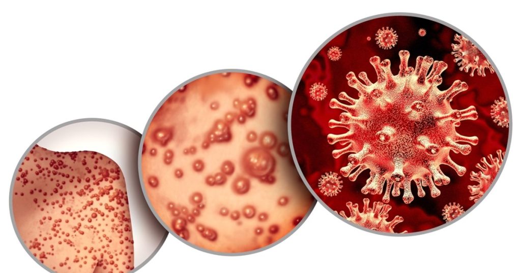 The WHO reports that monkeypox continues to represent a public health emergency