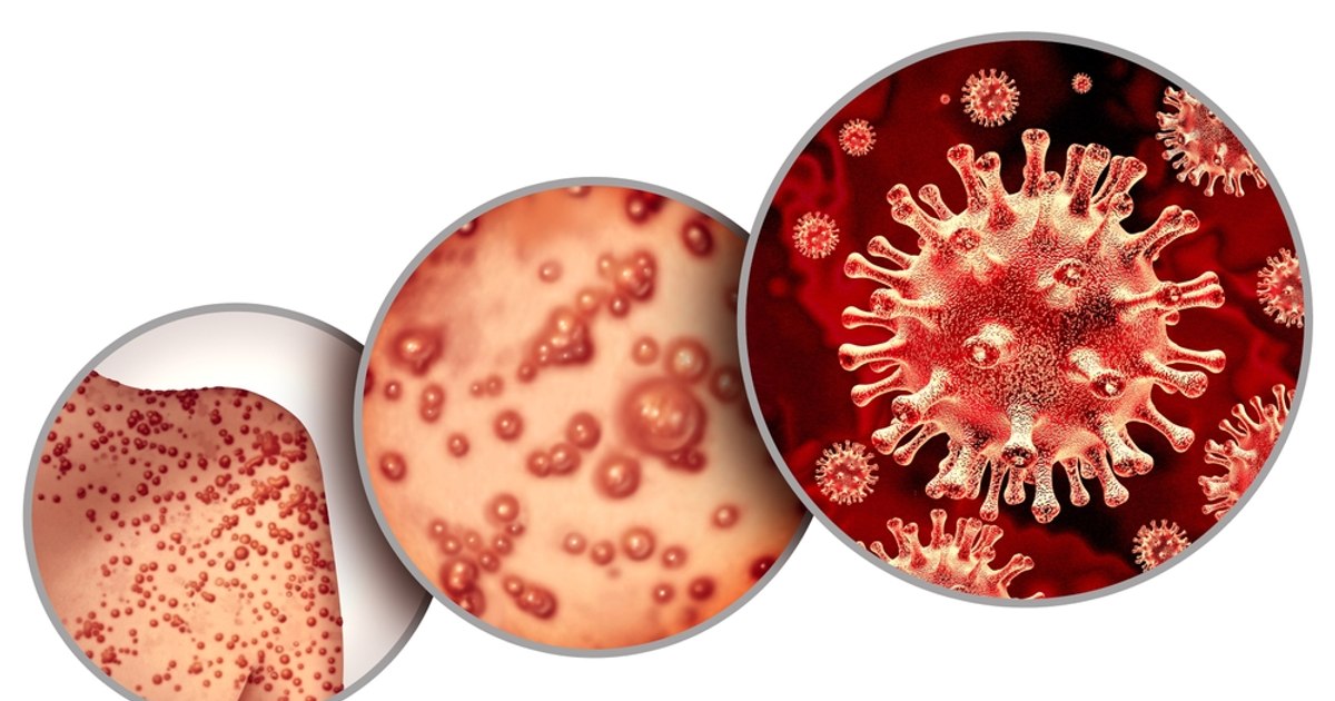 The WHO reports that monkeypox continues to represent a public health emergency