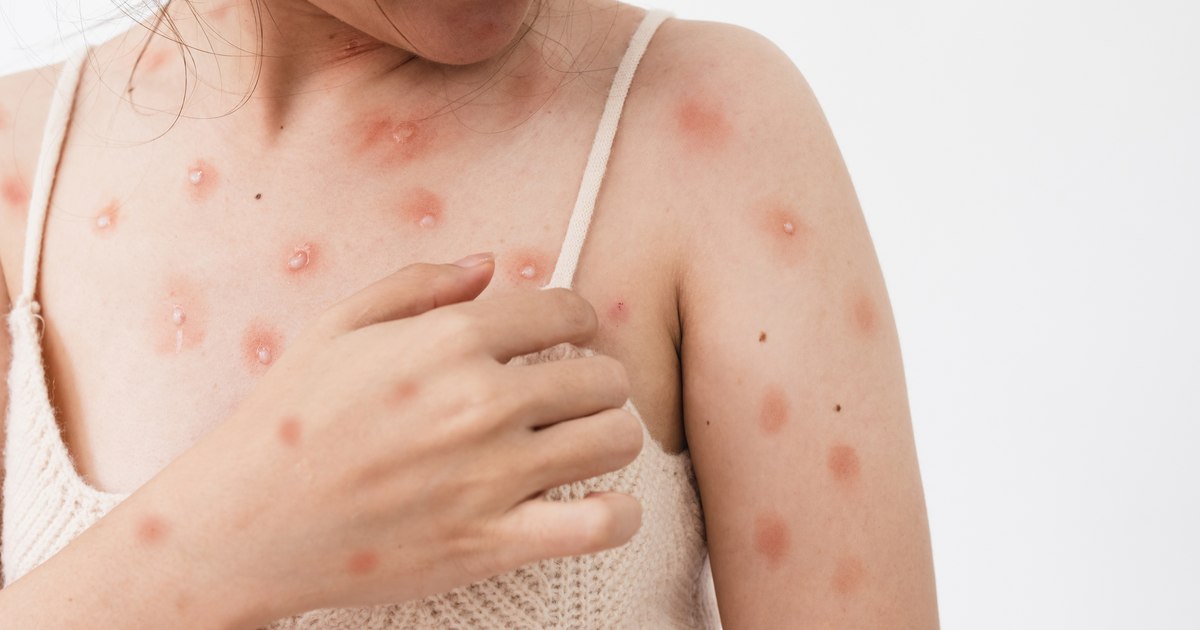 The first case of infection with the new mpox strain, confirmed in California