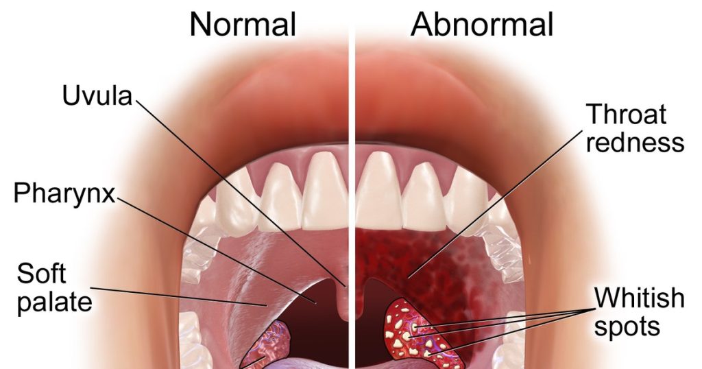 What are the risks of removing tonsils in childhood. The disturbing conclusions of a study carried out by international specialists
