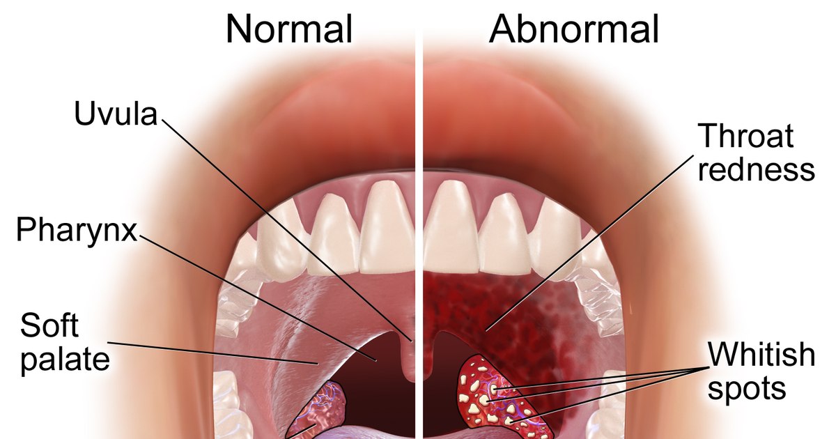What are the risks of removing tonsils in childhood. The disturbing conclusions of a study carried out by international specialists