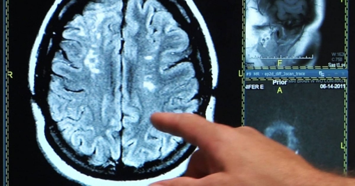 A revolutionary procedure that unlocks the brain circulation will be used at a hospital in Moldova: "The chances of complete recovery" increase "