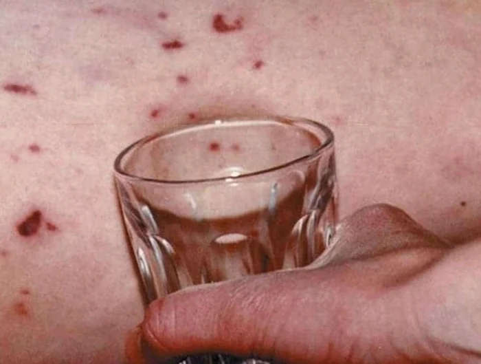 The test can be done with a photo glass: FB/Children's Virtual Hospital