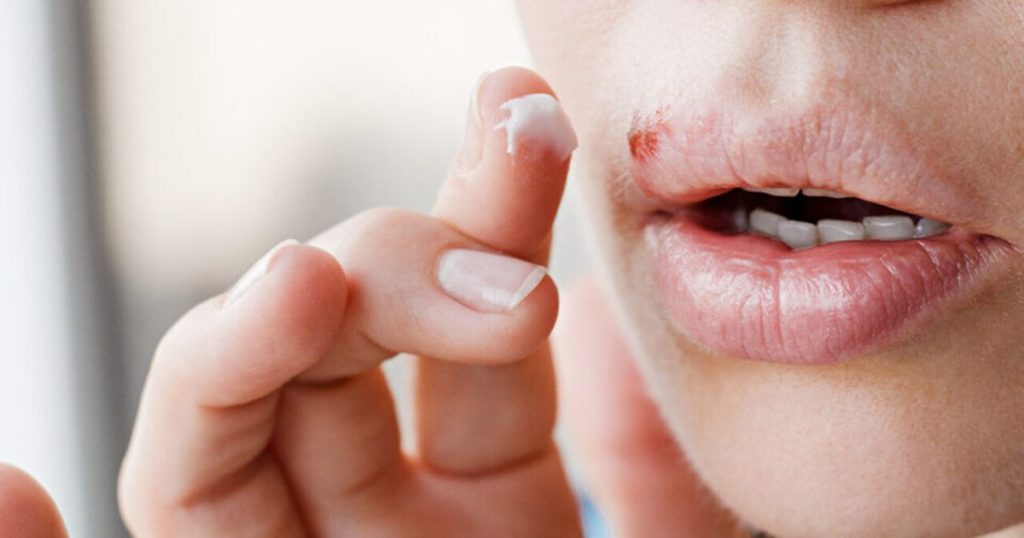How could antivirals for oral herpes reduce the risk of Alzheimer
