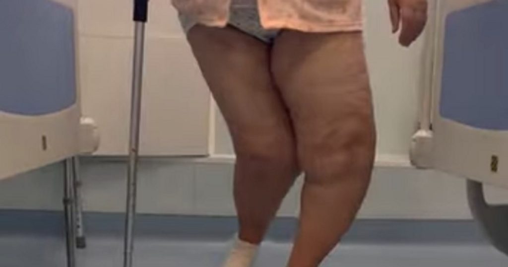 Video a woman with serious deformations at both knees, successfully treated in a hospital in Romania