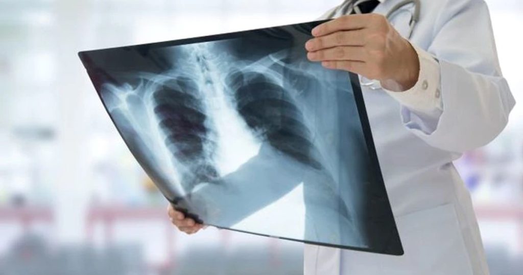 The ignored symptoms of lung cancer, the disease Ion Iliescu suffers from. "It has no pain receptors"