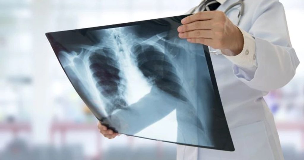 Symptoms of lung cancer, the disease that killed Ion Iliescu. Doctor: "Annually, in Romania, over 12,000 new cases are detected"