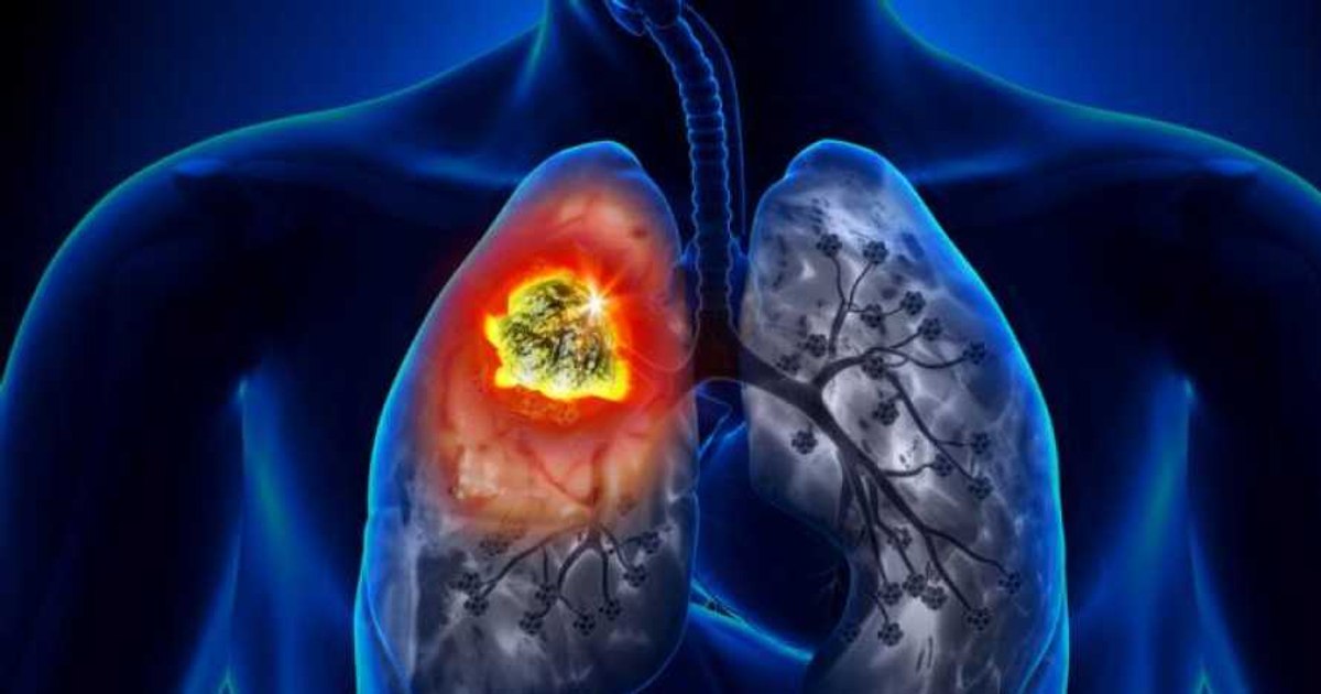 The affection that worries the specialists. Low survival rate, increasing incidence. Mahler: "The future doesn't sound good"