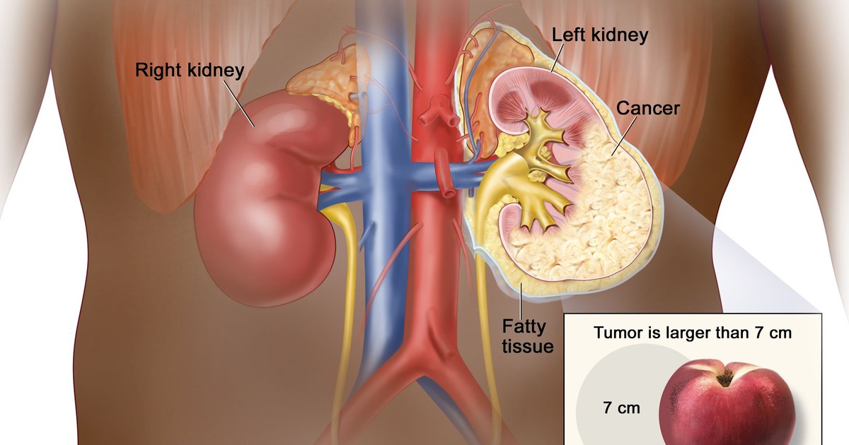 Revolution in transplants: The first universal kidney compatible with all blood groups transplanted to humans