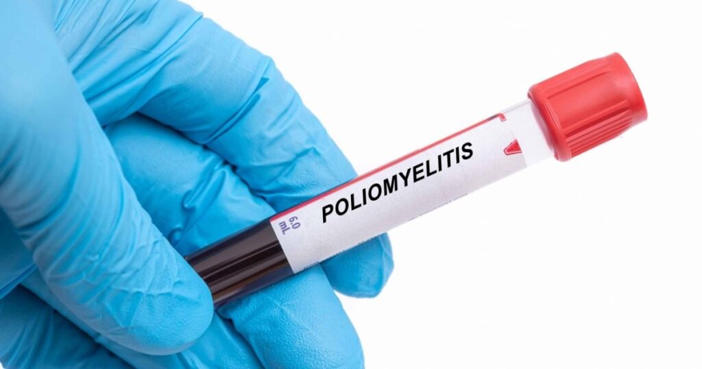 The wild form of the polio virus, discovered in sewage in Germany. Romanian epidemiologist: "People must understand that it's no joke"