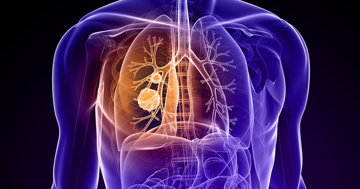 World premiere: A European country is testing the vaccine that could prevent lung cancer