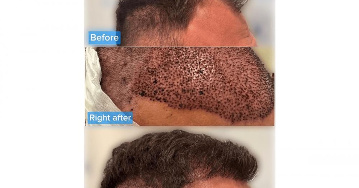 A hair implant clinic in Bucharest attracts dozens of patients from the EU, USA and Canada every year