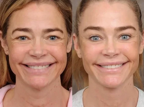American actress Denise Richards images before and after face lift PHOTO: Instagram